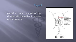 Female genital mutilations type and complications | PPTX