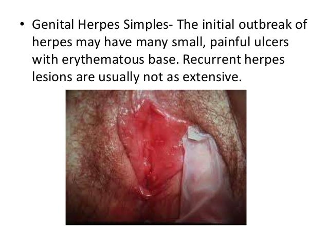 Genital Herpes - Genital Herpes Symptoms - STDcheck.com