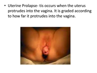 • Uterine Prolapse- tis occurs when the uterus
protrudes into the vagina. It is graded according
to how far it protrudes into the vagina.
 