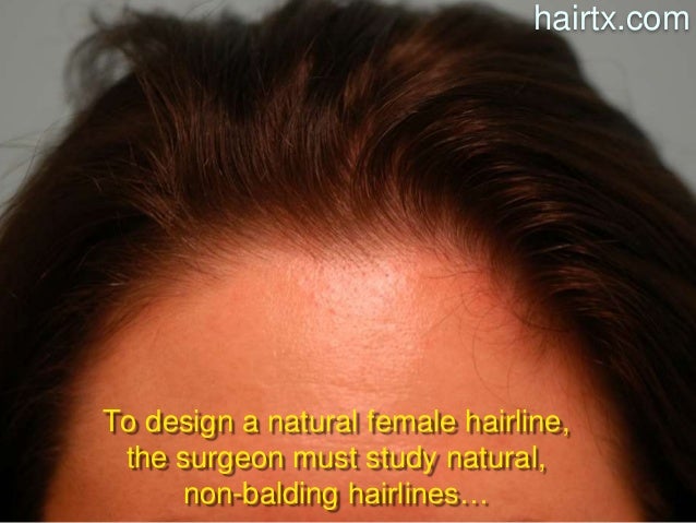Dallas Female Hair Loss Hair Restoration Principles By Dr Sam Lam