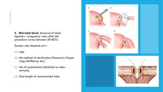 Pomeroy Method Female Infertility presentation | PPTX