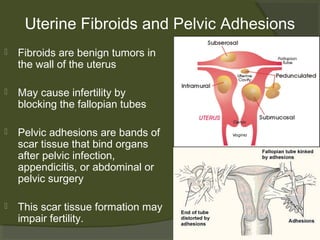 Uterine Fibroids and Pelvic Adhesions


Fibroids are benign tumors in
the wall of the uterus



May cause infertility by
blocking the fallopian tubes



Pelvic adhesions are bands of
scar tissue that bind organs
after pelvic infection,
appendicitis, or abdominal or
pelvic surgery



This scar tissue formation may
impair fertility.

 