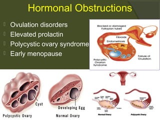 Hormonal Obstructions





Ovulation disorders
Elevated prolactin
Polycystic ovary syndrome
Early menopause

 