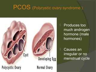 PCOS (Polycystic ovary syndrome )


Produces too
much androgen
hormone (male
hormones)



Causes an
irregular or no
menstrual cycle

 