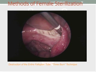 dr subha/8th sem pbl 12
Methods of Female Sterilization
Destruction of the Entire Fallopian Tube: “Three Burn” Technique
 