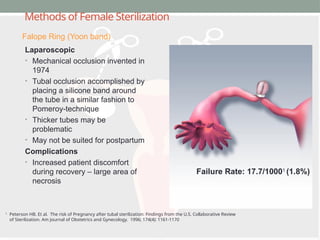 Methods of Female Sterilization
Laparoscopic
• Mechanical occlusion invented in
1974
• Tubal occlusion accomplished by
placing a silicone band around
the tube in a similar fashion to
Pomeroy-technique
• Thicker tubes may be
problematic
• May not be suited for postpartum
Complications
• Increased patient discomfort
during recovery – large area of
necrosis
1
Peterson HB. Et al. The risk of Pregnancy after tubal sterilization: Findings from the U.S. Collaborative Review
of Sterilization. Am Journal of Obstetrics and Gynecology. 1996; 174(4): 1161-1170
Falope Ring (Yoon band)
Failure Rate: 17.7/10001
(1.8%)
 