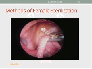 dr subha/8th sem pbl 16
Methods of Female Sterilization
Hulka Clip
 
