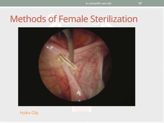 dr subha/8th sem pbl 17
Methods of Female Sterilization
Hulka Clip
 