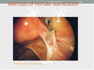 dr subha/8th sem pbl 19
Methods of Female Sterilization
Filshie®
Clip – Laparoscopy
 
