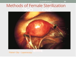 dr subha/8th sem pbl 20
Methods of Female Sterilization
Filshie®
Clip – Laparoscopy
 