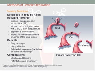 Methods of Female Sterilization
Developed in 1930 by Ralph
Hayword Pomeroy
• Incision – suprapubic and
subumbilical (PP)
• Isthmic portion is ligated twice
with 0 or 2-0 plain catgut suture
• Segment is then excised
• Inspect for hemostasis and the
presence of the tubal lumen
Benefits
• Easy technique
• Highly effective
• Relatively inexpensive (excluding
lab costs for pathology)
Complications
• Infection and bleeding
• Potential ectopic pregnancy
1
Pregnancy After Tubal Sterilization with Bi-Polar Electrocoagulation. Obstetrics and GYN. August
1999 Volume 94. Herbert B Petterson et al for the CREST Working Group
Pomeroy Technique
Tied
Cut
Final result
Failure Rate: 7.5/1000
 