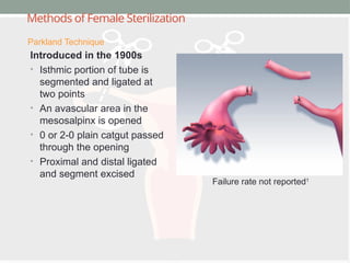 Methods of Female Sterilization
Introduced in the 1900s
• Isthmic portion of tube is
segmented and ligated at
two points
• An avascular area in the
mesosalpinx is opened
• 0 or 2-0 plain catgut passed
through the opening
• Proximal and distal ligated
and segment excised
Parkland Technique
Failure rate not reported1
 