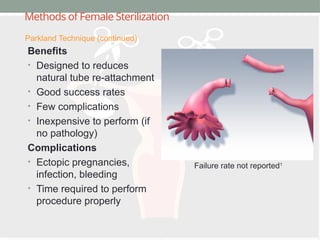 Methods of Female Sterilization
Benefits
• Designed to reduces
natural tube re-attachment
• Good success rates
• Few complications
• Inexpensive to perform (if
no pathology)
Complications
• Ectopic pregnancies,
infection, bleeding
• Time required to perform
procedure properly
Parkland Technique (continued)
Failure rate not reported1
 