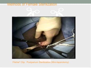 Methods of Female Sterilization
Filshie®
Clip: Postpartum Sterilization (Mini-laparotomy)
 