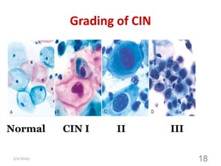 Grading of CIN
5/9/2023 18
Normal CIN I II III
 