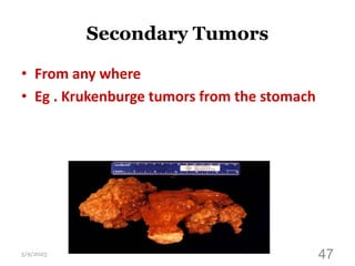 Secondary Tumors
• From any where
• Eg . Krukenburge tumors from the stomach
5/9/2023 47
 