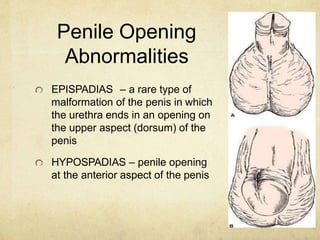 Penile Opening
Abnormalities
EPISPADIAS – a rare type of
malformation of the penis in which
the urethra ends in an opening...