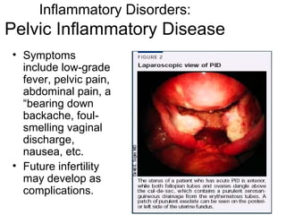 Inflammatory Disorders:
Pelvic Inflammatory Disease
• Symptoms
  include low-grade
  fever, pelvic pain,
  abdominal pain, a
  “bearing down
  backache, foul-
  smelling vaginal
  discharge,
  nausea, etc.
• Future infertility
  may develop as
  complications.
 
