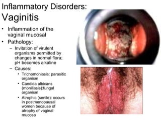 Inflammatory Disorders:
Vaginitis
• Inflammation of the
  vaginal mucosal
• Pathology:
   – Invitation of virulent
     organisms permitted by
     changes in normal flora;
     pH becomes alkaline
   – Causes:
      • Trichomoniasis: parasitic
        organism
      • Candida albicans
        (moniliasis):fungal
        organism
      • Atrophic (senile): occurs
        in postmenopausal
        women because of
        atrophy of vaginal
        mucosa
 