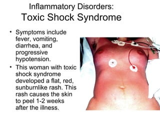 Inflammatory Disorders:
    Toxic Shock Syndrome
• Symptoms include
  fever, vomiting,
  diarrhea, and
  progressive
  hypotension.
• This woman with toxic
  shock syndrome
  developed a flat, red,
  sunburnlike rash. This
  rash causes the skin
  to peel 1-2 weeks
  after the illness.
 