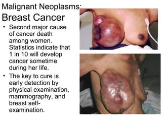 Malignant Neoplasms:
Breast Cancer
• Second major cause
  of cancer death
  among women.
  Statistics indicate that
  1 in 10 will develop
  cancer sometime
  during her life.
• The key to cure is
  early detection by
  physical examination,
  mammography, and
  breast self-
  examination.
 