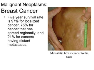 Malignant Neoplasms:
Breast Cancer
 • Five year survival rate
   is 97% for localized
   cancer, 76% for
   cancer that has
   spread regionally, and
   21% for cancers
   having distant
   metastases.

                             Metastatic breast cancer to the
                                         back
 