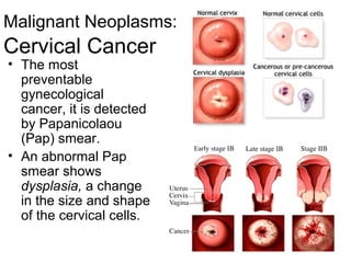 Malignant Neoplasms:
Cervical Cancer
• The most
  preventable
  gynecological
  cancer, it is detected
  by Papanicolaou
  (Pap) smear.
• An abnormal Pap
  smear shows
  dysplasia, a change
  in the size and shape
  of the cervical cells.
 