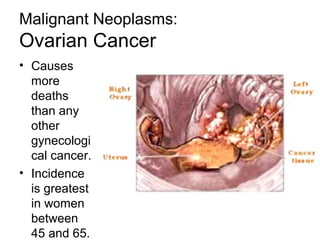 Malignant Neoplasms:
Ovarian Cancer
• Causes
  more
  deaths
  than any
  other
  gynecologi
  cal cancer.
• Incidence
  is greatest
  in women
  between
  45 and 65.
 