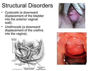Structural Disorders
• Cystocele (a downward
  displacement of the bladder
  into the anterior vaginal
  wall).
• Urethrocele (a downward
  displacement of the urethra
  into the vagina).
 