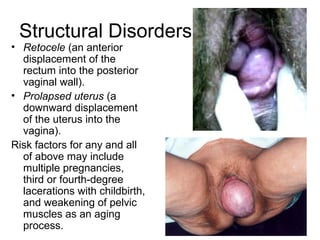 Structural Disorders
• Retocele (an anterior
  displacement of the
  rectum into the posterior
  vaginal wall).
• Prolapsed uterus (a
  downward displacement
  of the uterus into the
  vagina).
Risk factors for any and all
  of above may include
  multiple pregnancies,
  third or fourth-degree
  lacerations with childbirth,
  and weakening of pelvic
  muscles as an aging
  process.
 