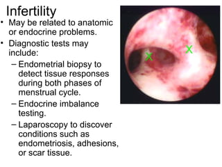 Infertility
• May be related to anatomic
  or endocrine problems.
• Diagnostic tests may
  include:
   – Endometrial biopsy to
     detect tissue responses
     during both phases of
     menstrual cycle.
   – Endocrine imbalance
     testing.
   – Laparoscopy to discover
     conditions such as
     endometriosis, adhesions,
     or scar tissue.
 