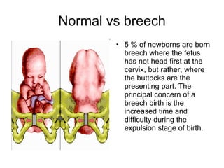 Normal vs breech <ul><li>5 % of newborns are born breech where the fetus has not head first at the cervix, but rather, whe...