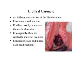 female-urethral-diverticula-pptx