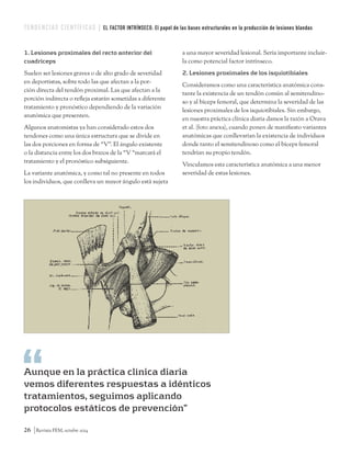 TENDENCIAS CIENTÍFICAS EL FACTOR INTRÍNSECO: El papel de las bases estructurales en la producción de lesiones blandas 
1. Lesiones proximales del recto anterior del 
cuadriceps 
Suelen ser lesiones graves o de alto grado de severidad 
en deportistas, sobre todo las que afectan a la por-ción 
directa del tendón proximal. Las que afectan a la 
porción indirecta o refleja estarán sometidas a diferente 
tratamiento y pronóstico dependiendo de la variación 
anatómica que presenten. 
Algunos anatomistas ya han considerado estos dos 
tendones como una única estructura que se divide en 
las dos porciones en forma de “V”. El ángulo existente 
o la distancia entre los dos brazos de la “V “marcará el 
tratamiento y el pronóstico subsiguiente. 
La variante anatómica, y como tal no presente en todos 
los individuos, que conlleva un mayor ángulo está sujeta 
26 Revista FEM, octubre 2014 
a una mayor severidad lesional. Sería importante incluir-la 
como potencial factor intrínseco. 
2. Lesiones proximales de los isquiotibiales 
Consideramos como una característica anatómica cons-tante 
la existencia de un tendón común al semitendino-so 
y al bíceps femoral, que determina la severidad de las 
lesiones proximales de los isquiotibiales. Sin embargo, 
en nuestra práctica clínica diaria damos la razón a Orava 
et al. (foto anexa), cuando ponen de manifiesto variantes 
anatómicas que conllevarían la existencia de individuos 
donde tanto el semitendinoso como el bíceps femoral 
tendrían su propio tendón. 
Vinculamos esta característica anatómica a una menor 
severidad de estas lesiones. 
Aunque en la práctica clínica diaria 
vemos diferentes respuestas a idénticos 
tratamientos, seguimos aplicando 
protocolos estáticos de prevención” 
 