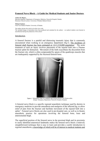 Femoral Nerve Block – A Guide for Medical Students and Junior Doctors.
Andrew R. Bogacz.
Specialty Registrar, Department of Emergency Medicine, Ninewells Hospital, Dundee.
Honorary Clinical Lecturer, University of Dundee Medical School.
Michael Jamison.
Final Year Medical Student, University of Dundee.
The authors declare this article to be their own work.
The included images of procedures have been produced and simulated by the authors – no medical students were harmed or
anaesthetised during the production of this article!
Introduction.
A femoral fracture is a painful and distressing traumatic injury that is commonly
encountered when working in an emergency department (fig.1). The incidence of
femoral shaft fracture has been estimated at 1.0-1.3/10,000 population.1
The acute
treatment of such an injury involves placement of the injured limb into a Thomas
traction splint for distraction. Movement of the limb exacerbates the discomfort from
the fracture site, which is often compounded by spasm of the quadriceps muscles that
are inadequately supported by the fractured femoral bone.
Figure 1. Radiograph image of a midshaft right femoral fracture and Thomas splint.
[Image: Emergency Department, Ninewells Hospital, Dundee]
A femoral nerve block is a specific regional anaesthetic technique used by doctors in
emergency medicine to provide anaesthesia and analgesia of the affected leg, to allow
relief of pain from the fracture and facilitate movement of the injured limb into a
splint.2
Femoral nerve blocks are also used in pre-hospital care, as well as in theatre
anaesthetic practice for operations involving the femoral bone, knee and
anteriomedial thigh.
The superficial position of the femoral nerve in the proximal thigh and its proximity
to easily identified anatomical landmarks makes the femoral nerve block a relatively
straightforward technique that is easy to learn and provides a useful introduction to
regional anaesthesia; a knowledge of which will be of interest to medical students and
 
