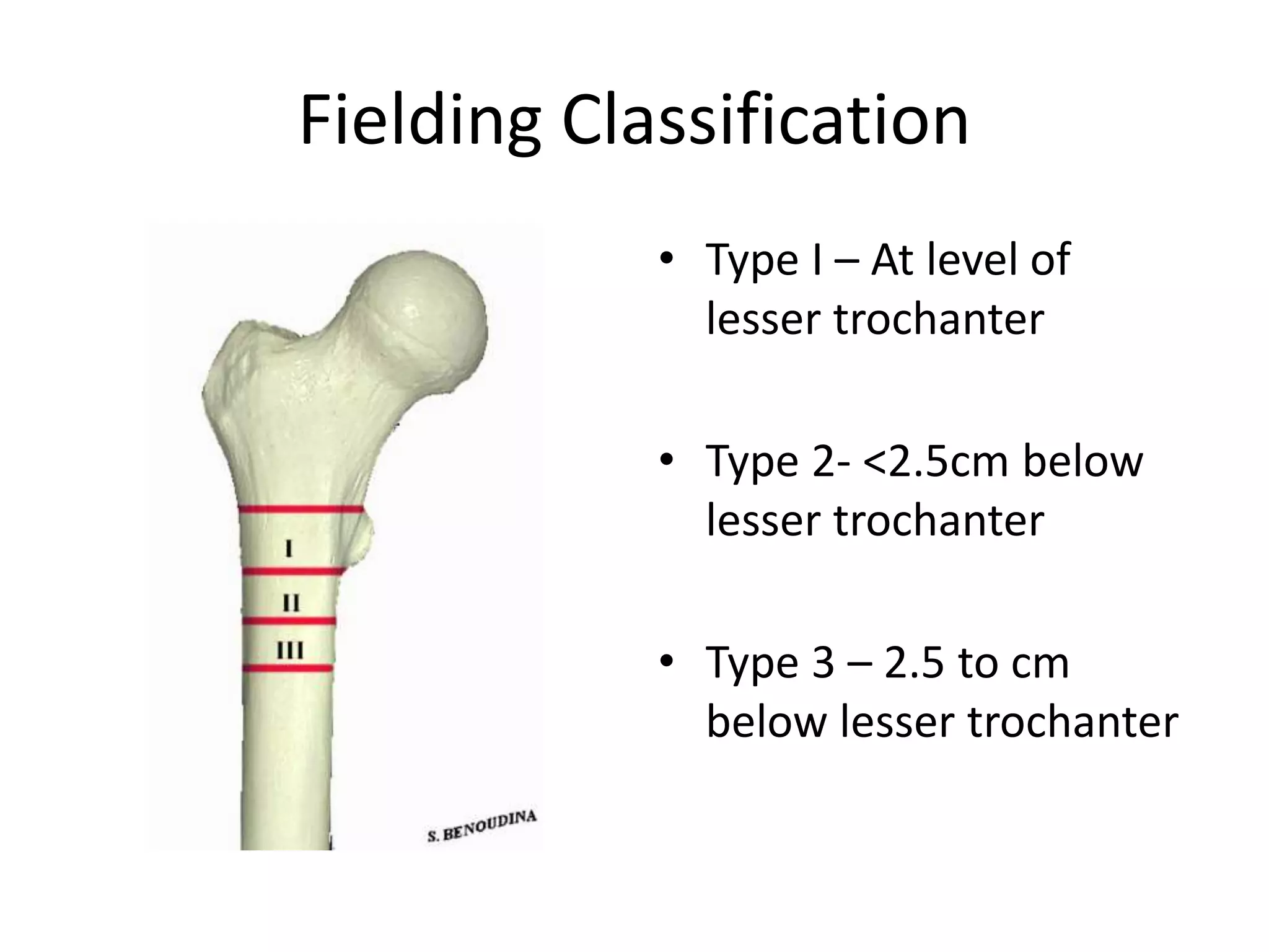 Femoral fracture PPT