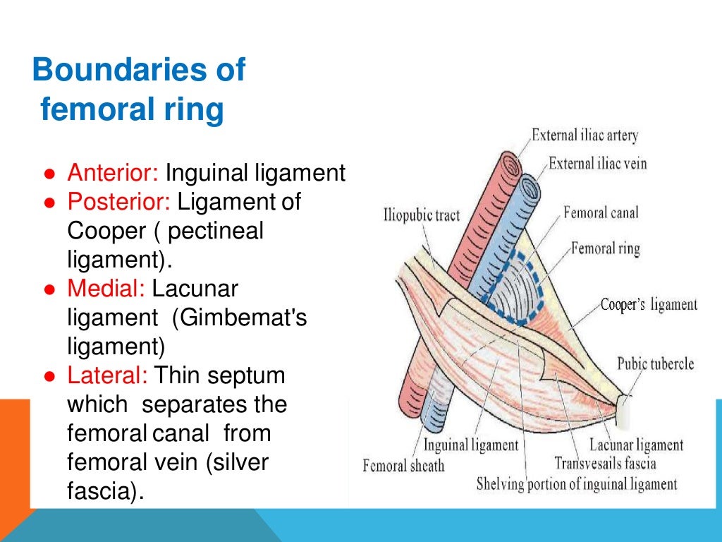 Femoral hernia