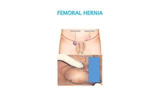 FEMORAL HERNIA
 
