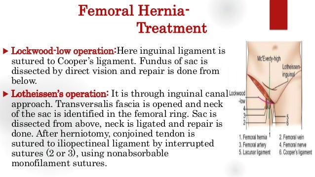 sex after a femoral hernia surgery sex after a femoral hernia surgery