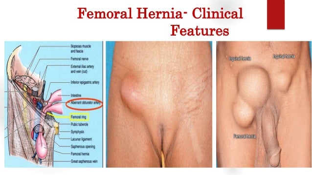 Hernia Pictures 21