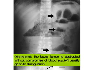 Obstructed:  the bowel lumen is obstructed without compromise of blood supply—usually go on to strangulation 