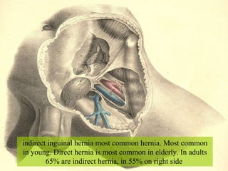 indirect inguinal hernia most common hernia. Most common in young. Direct hernia is most common in elderly. In adults 65% are indirect hernia, in 55% on right side  
