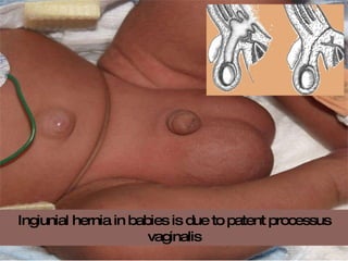 Ingiunial hernia in babies is due to patent processus vaginalis 