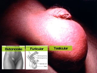 Funicular Bubonocele Testicular 