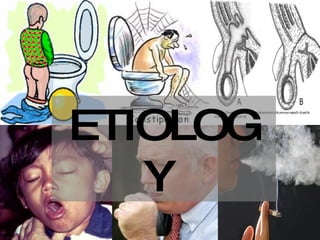 ETIOLOGY  