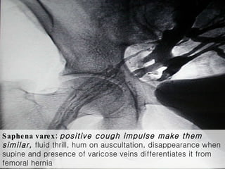 Saphena varex:   positive cough impulse make them similar,  fluid thrill, hum on auscultation, disappearance when supine and presence of varicose veins differentiates it from femoral hernia 