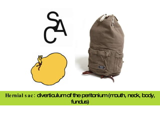 Hernial sac:  diverticulum of the peritonium (mouth, neck, body, fundus) 