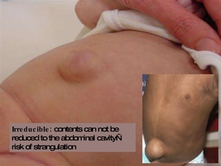 Irreducible:  contents can not be reduced to the abdominal cavity—risk of strangulation 