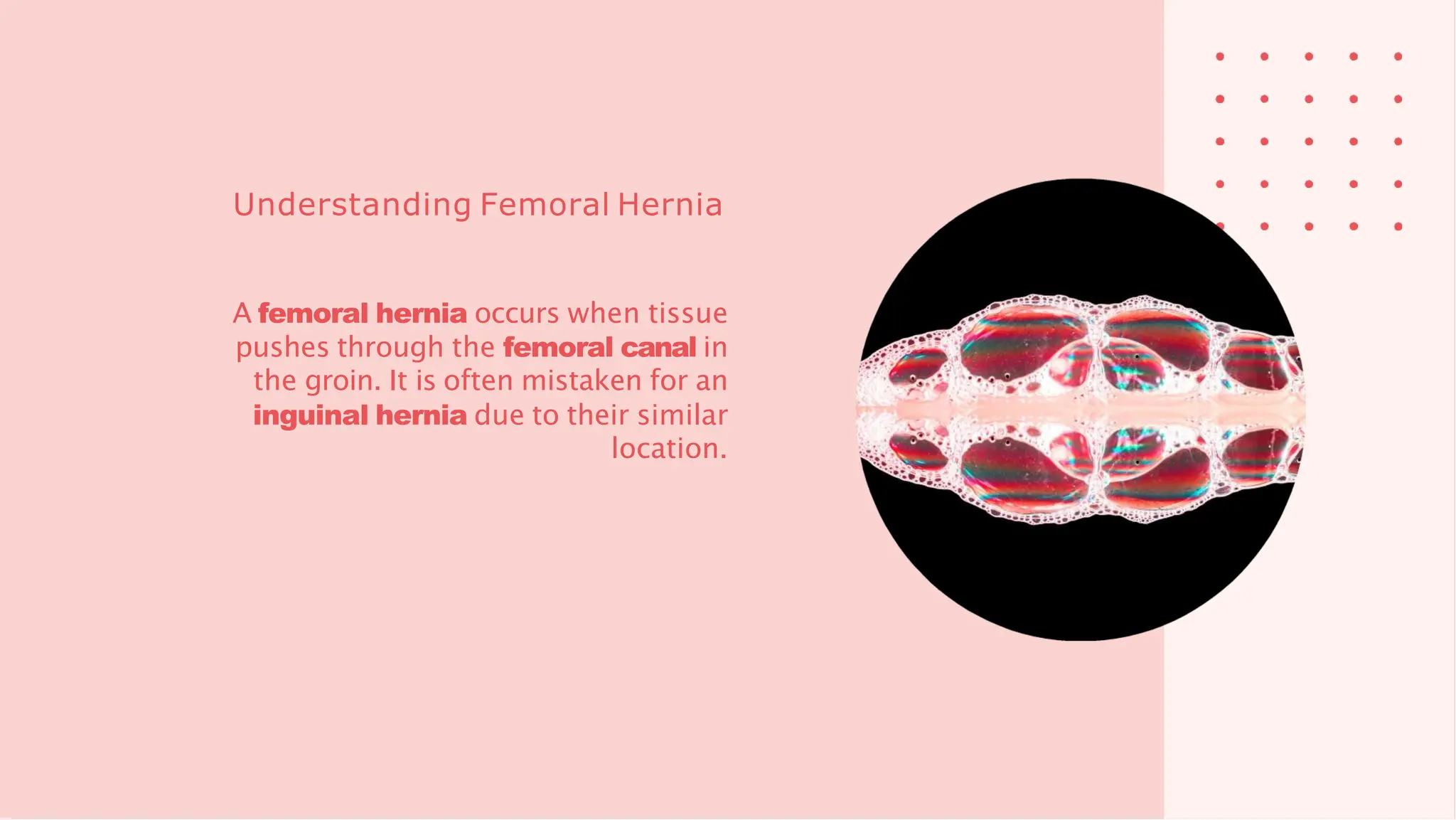 Femoral Hernia , treatment, diagnosis.pptx | Physical Therapy | Wellness