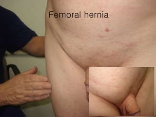Femoral hernia 
